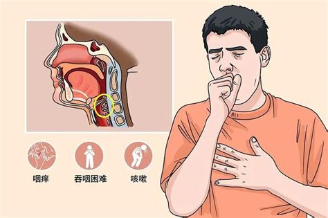 秋季咽痛、咽痒、干咳不断专家提醒：咽喉炎不是小问题，一定要重视！ 知乎