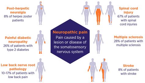 Most Common Types Of Neuropathic Pain And Symptoms Nerve Pain Treatment ...