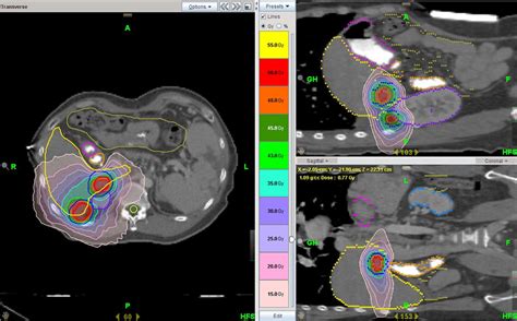 target volumes and dose distribution for helical IMrt based-sbrt. ITV ...