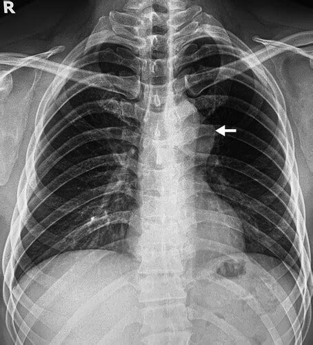 Saccular Aortic Arch Aneurysm In The Cardiovocal Syndrome Circulation