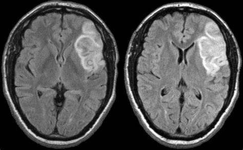 Dr Balaji Anvekar FRCR: Ischemic stroke and Vascular territories of Brain