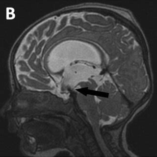 Sagittal Cut Of A Fast Spin Echo T Weighted Sequence Illustrating The