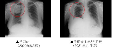 臨床例⑤：ステージⅢbの肺がんの再発と頸部リンパ節転移（72歳女性） フコイダンラボ