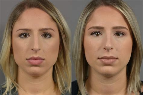 Nose Surgery Before After Long Island Dr Marotta