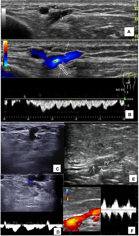 Application Of The Ankle Pump Method In A Sitting Position To Evaluate