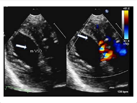 A One Day Female 2D Echocardiogram And Color Flow Doppler Confirmation