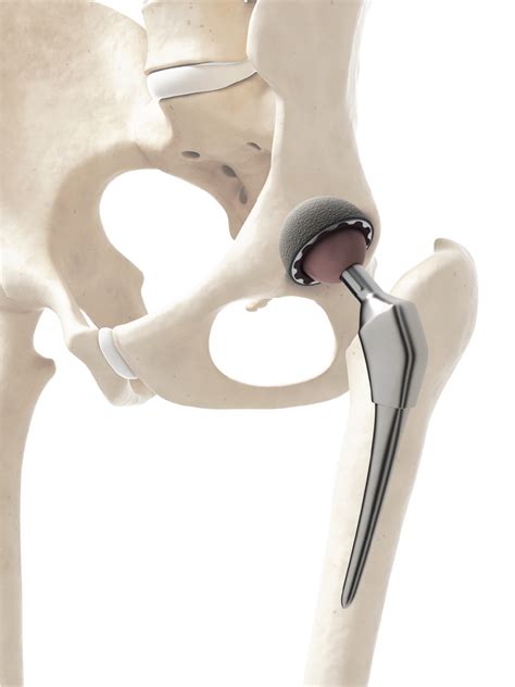 Computer Assisted Total Hip Replacement Bloodless Technique In Greece