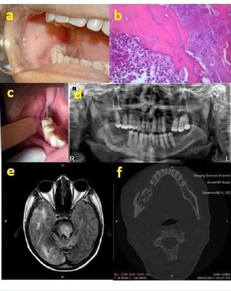 Figure 1 from Medication-Related Osteonecrosis of the Jaw and Low-Level ...