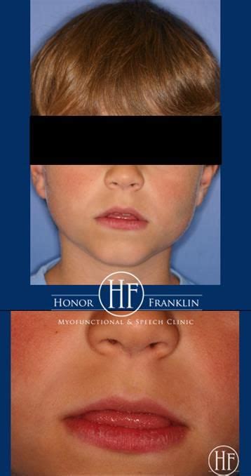 Honor Franklin Myofunctional Speech Clinic Myofunctional Therapy