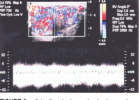 Figure 3 From Testicular Adrenal Rest Tumors Associated With Congenital