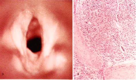 Figure From Solitary Plasmacytoma Of The Larynx And Upper Trachea