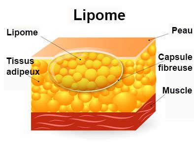 Lipome symptômes traitement définition docteurclic