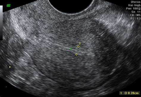 Dr.Malpani's Blog: How to improve a poor uterine lining