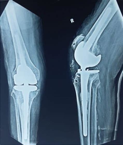 Immediate Postoperative Ap And Lateral X Rays Download Scientific Diagram