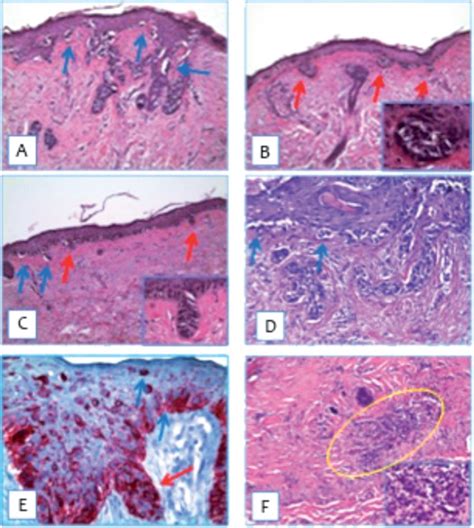 Clinical Dermoscopic And Histological Features Of A Combined Tumor