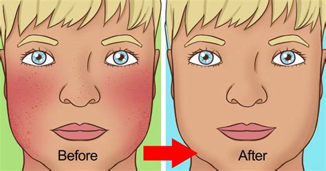 8 Natural Ways To Treat Rosacea