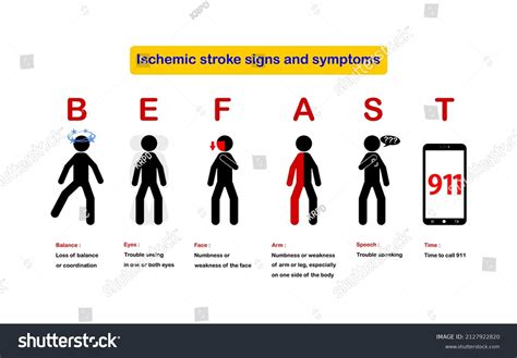 144 Ischemic Stroke Sign And Symptoms Images, Stock Photos & Vectors | Shutterstock