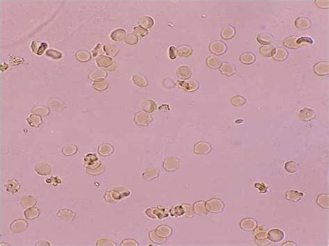 Urinalysis Lecture 6 Microscopic Examination Of Urine LMU Flashcards