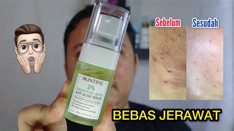 Serum Jerawat Terampuh Skintific 2 Salicylic Acid Anti Acne Serum Review Youtube