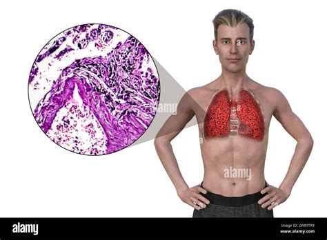 Pulmones Fumadores Fotograf As E Im Genes De Alta Resoluci N Alamy