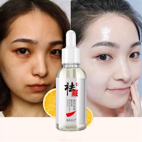 Whitening Freckle Facial Serum Dark Corrector Removing Melasma Dark