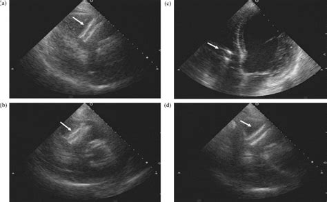 Complete Atrioventricular Block Due To Venous Stent Migration From