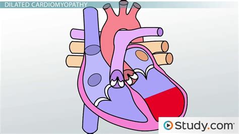 Dilated Cardiomyopathy: Causes, Symptoms, Treatment, & Prognosis - Video & Lesson Transcript ...