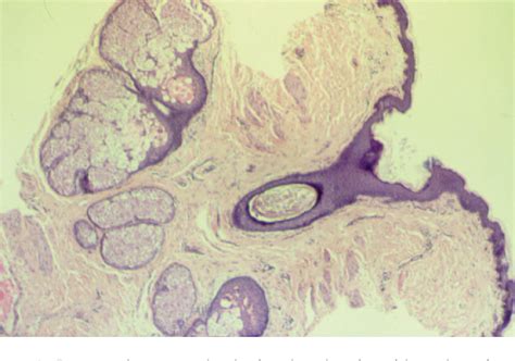 Figure 2 From Inflammation Of Montgomery Glands Semantic Scholar