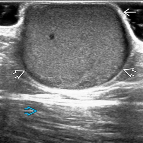 Epidermoid Cyst | Radiology Key