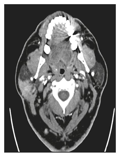 Axial Ct With Contrast Shows A Mass In The Superficial Lobe Of The Download Scientific Diagram