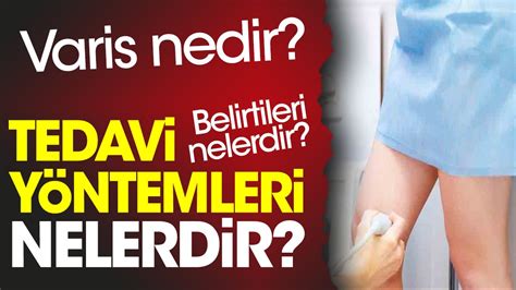 Varis Nedir Varis Belirtileri Nelerdir Varis Tedavi Y Ntemleri Nelerdir