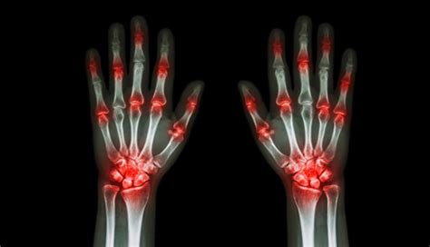 Pain complexities in rheumatoid arthritis - Clinical Advisor