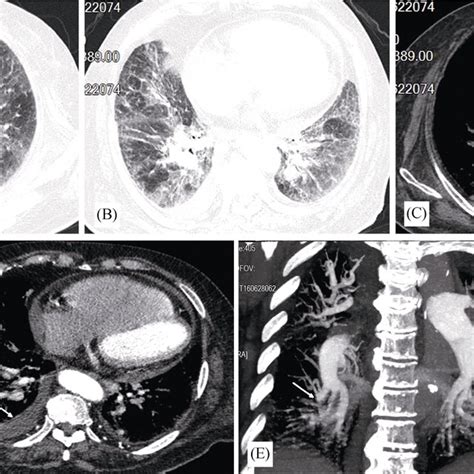 Chest Ct And Ct Angiography In A 82 Year Old Woman With Right Lower