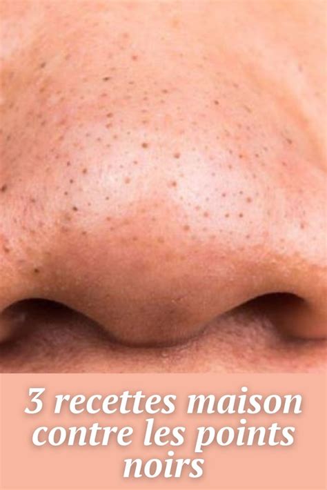 Recettes Maison Contre Les Points Noirs Astuces De Grand M Re