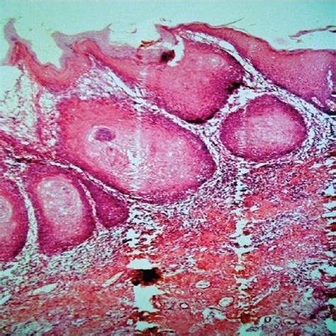 Degree of epithelial dysplasia | Download Scientific Diagram