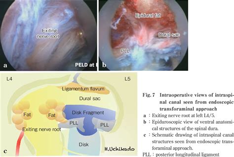 Figure From Microsurgical Anatomy Of The Lumbar Intervertebral