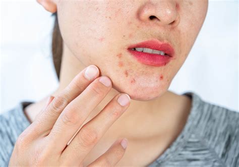 Red Small Spots On Skin Causes And Treatment Recibeauty