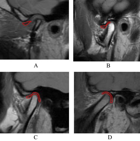 Classification Of Temporomandibular Joint Tmj Disc Position In