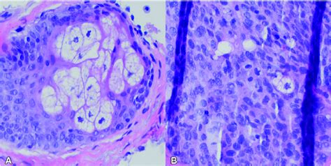 Histology Of Squamous Cell Carcinoma Clusters Of Sebocytes A And A Download Scientific