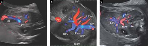 Persistent Right Umbilical Vein Ultrasound