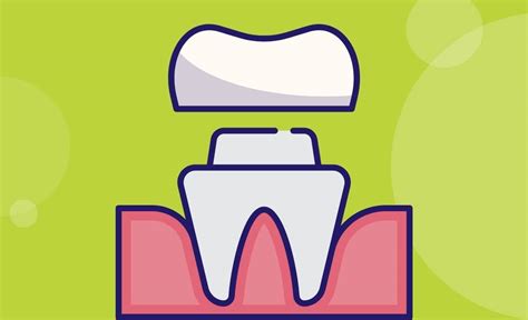 Dental Crown Types, Procedure, When It's Done, Cost, and More - Resurchify