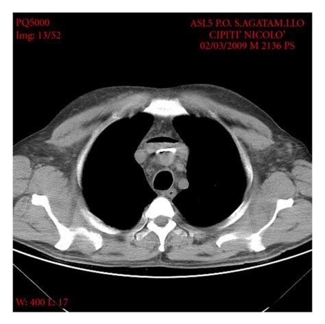 Ct Scan Showing Air Bubbles Trapped At The Level Of The Venous