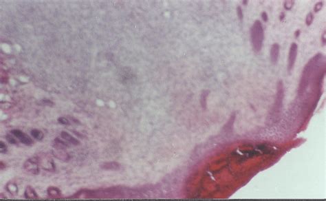 site of injury showing formation of the basal layer of epidermis below ... 