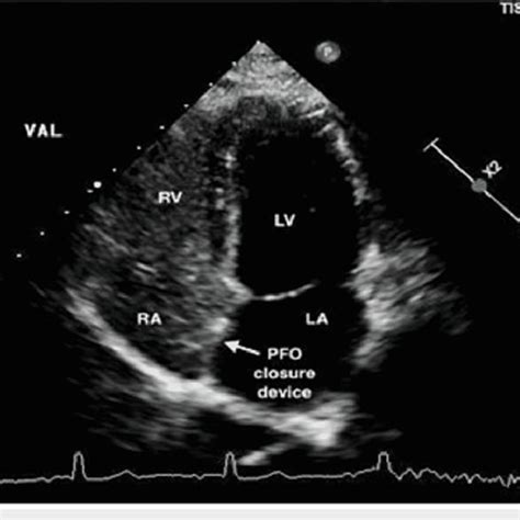 Transthoracic Echocardiogram With Bubble Study Postprocedure