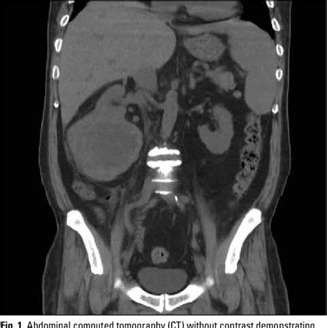 Figure From Renal Cell Carcinoma With Secondary Hemophagocytic