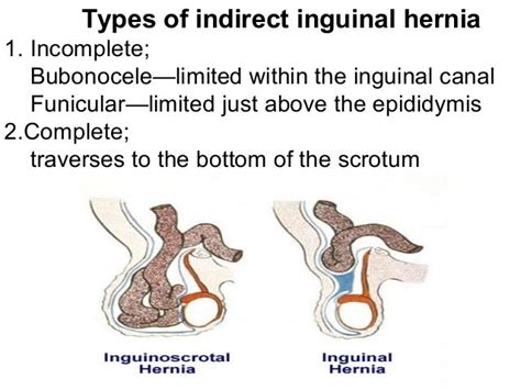 9 hernia