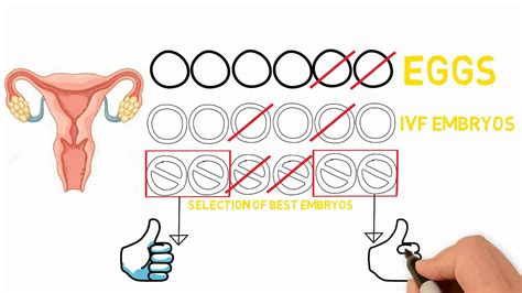 Ivf Procedure Steps Explained In English Youtube