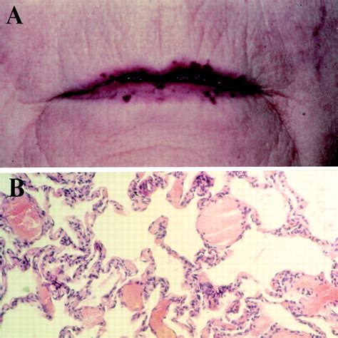 Hereditary Hemorrhagic Telangiectasia Histology