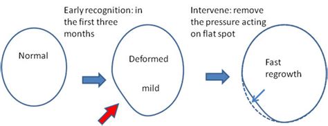 Plagiocephaly – Prevention and Awareness using the Mimos Pillow