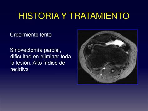 Ppt Malignizaci N De Sinovitis Villonodular Pigmentada A